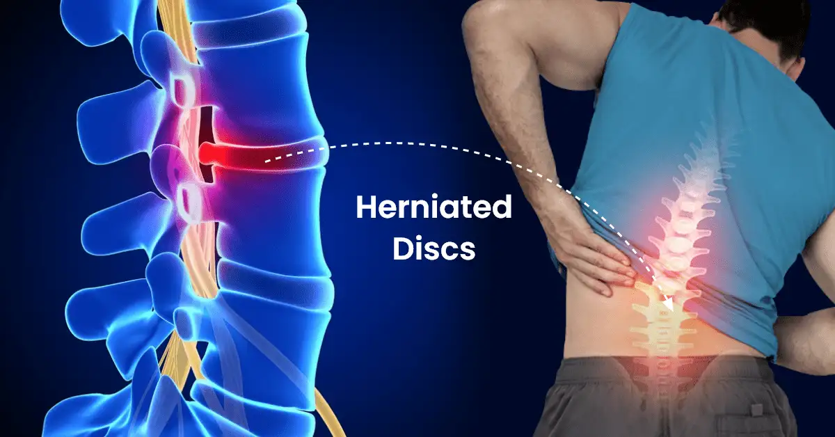 Best Collagen Supplements for Herniated Disc: Top Picks for Spine Health in 2024