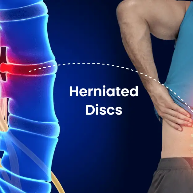 Best Collagen Supplements for Herniated Disc: Top Picks for Spine Health in 2024